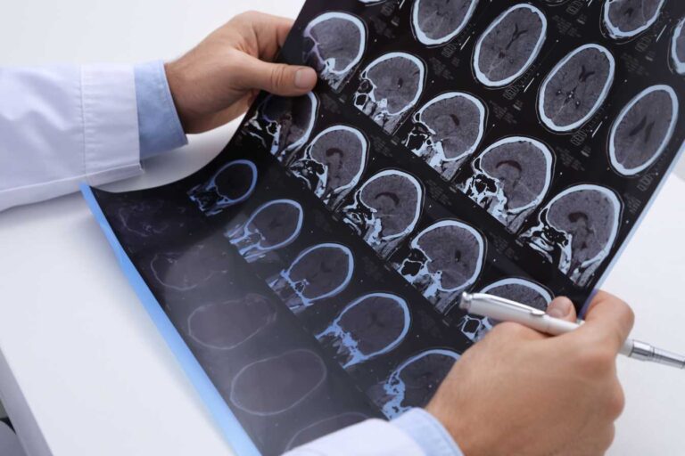 irm sclerose en plaque 1